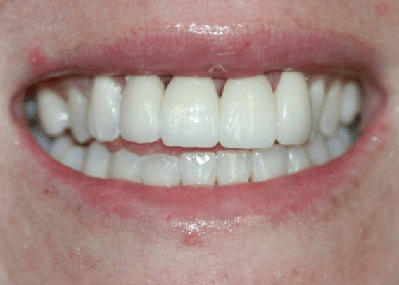after dental crowns